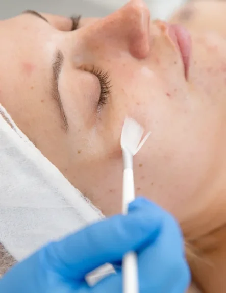 peeling chimico